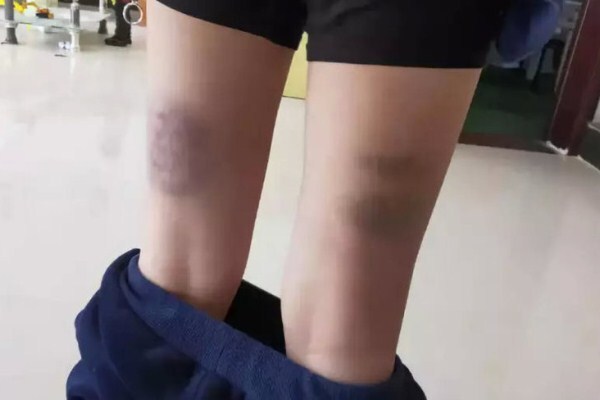 Bố mẹ sốc nặng vì con trai bị thầy giáo “tra tấn” bằng 100 roi