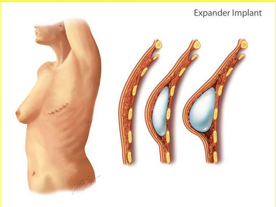 Đặt túi ngực có an toàn không phụ thuộc vào kiến thức của người đi thẩm mỹ