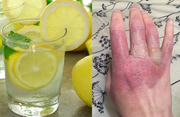 Để tay dính nước chanh đi phơi nắng, cô gái phải chịu hậu quả đau đớn này