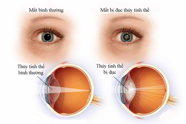 Cảnh báo: 7 biến chứng tiểu đường thường gặp nhất