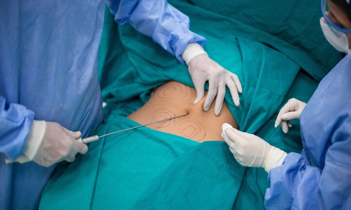 Chuyên gia thẩm mỹ D’vincy “giải oan” cho hút mỡ