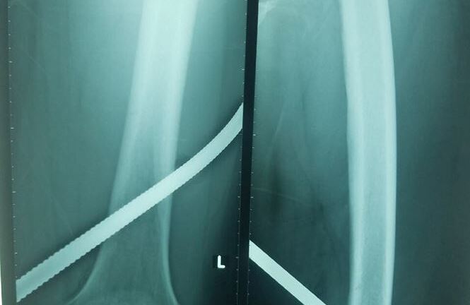 Ngã từ trên cao xuống, nam công nhân bị thanh sắt đâm xuyên đùi