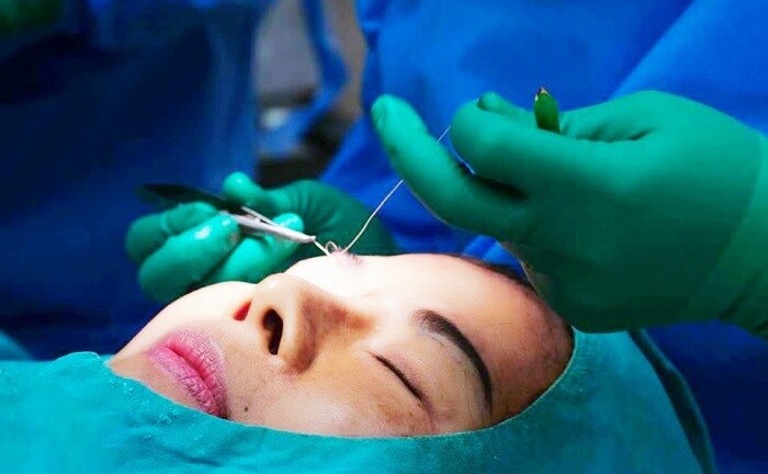 Theo chân khách hàng đến Viện thẩm mỹ D’vincy sửa mí hỏng