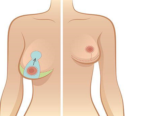 Treo ngực sa trễ là gì, có giống với nâng ngực không?