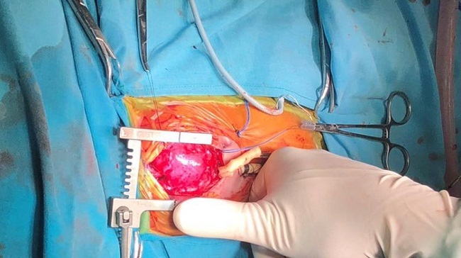 Tin tức đời sống mới nhất ngày 2/7/2019: Phẫu thuật tim hở cho bé sơ sinh nặng chỉ 1,6kg