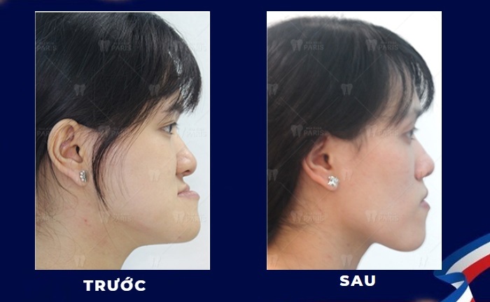 Đừng bỏ lỡ 3 xu thế niềng răng cực hot 2019 