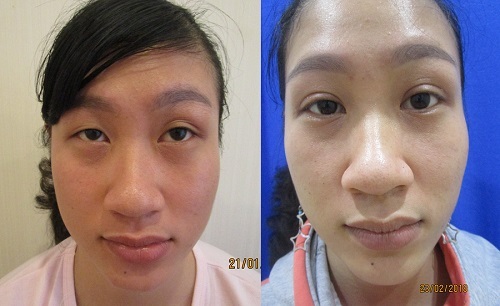 Nguyên nhân và cách chữa sụp mí mắt hiệu quả đến 99% cho người Việt