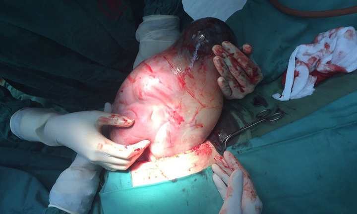 Hy hữu trường hợp mẹ sinh mổ mà con vẫn nằm nguyên trong túi ối