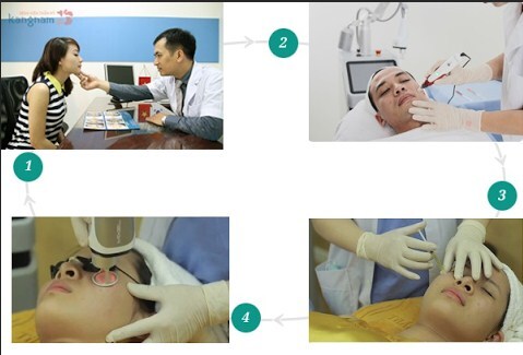 Giải pháp cải thiện 90% sẹo rỗ giúp da sáng mịn