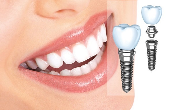Bật mí mẫu răng sứ tốt nhất khi cấy ghép Implant