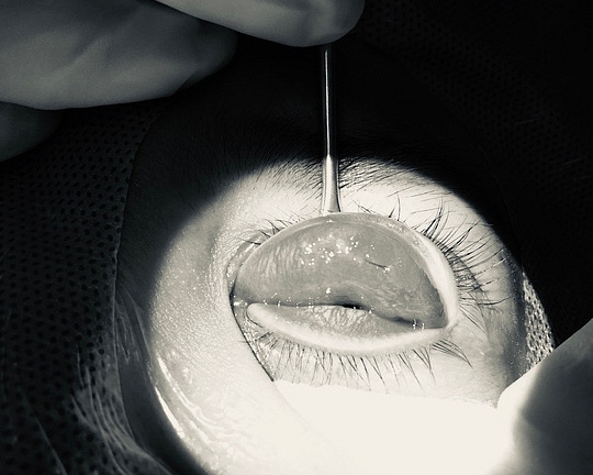 Cô gái 25 tuổi suýt mù mắt, loét giác mạc vì nhấn mí tại spa