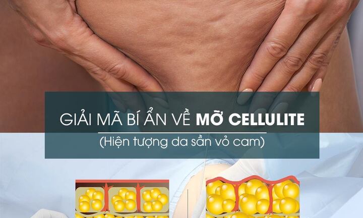 Xóa tan ám ảnh da sần vỏ cam sau hút mỡ tại D’vincy