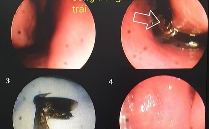Đi xe máy không đeo khẩu trang, người phụ nữ bị bướm bay vào... lỗ mũi