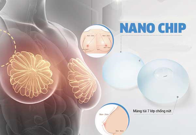 Những ưu điểm nổi trội của phương pháp thẩm mỹ nâng ngực nano chip
