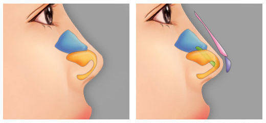 Có nâng mũi bọc sụn - Không còn lo bóng đỏ đầu mũi