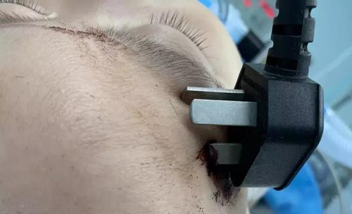 Mẹ sơ sẩy, con nhỏ bị kim móc, phích cắm đâm xuyên mặt