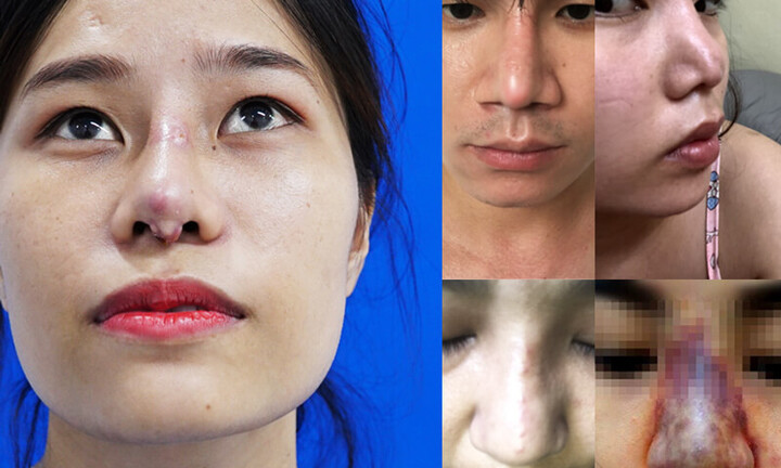 Nhiễm trùng sau nâng mũi do đâu? Khắc phục như thế nào?
