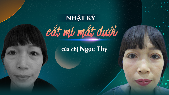 Nhật ký lấy lại đôi mắt tươi trẻ sau khi cắt mí mắt dưới của chị Ngọc Thy OKI