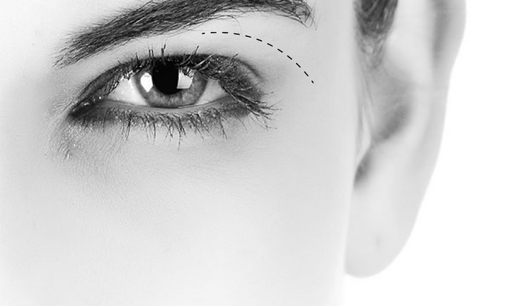 Nên chọn cắt mí mắt hay bấm mí mắt?