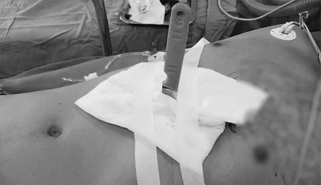 Cứu sống người đàn ông bị dao đâm xuyên gan, còn cắm trên bụng