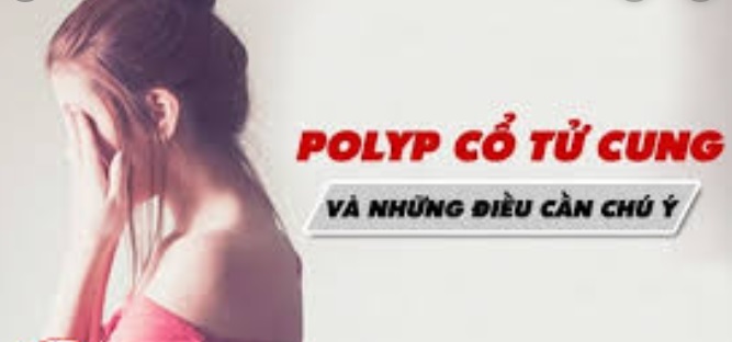 Phương pháp điều trị bệnh polyp cổ tử cung an toàn, hiệu quả 