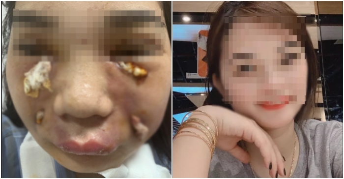 Sau một ngày tiêm mỡ tự thân vào mặt, cô gái trẻ phải nhập viện khẩn cấp vì nhiễm trùng