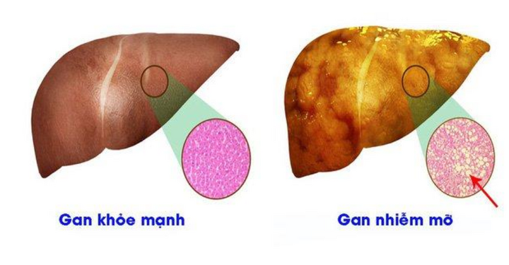Máu nhiễm mỡ nguy hiểm ra sao? Sử dụng Lipidcleanz giúp phòng ngừa biến chứng bệnh mỡ máu như thế nào?