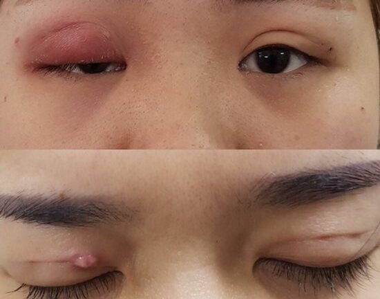 Ham nhấn mí giá rẻ, cô gái trẻ xinh đẹp suýt bị mù mắt vì gãy kim