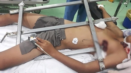 Nghệ An: Bé trai leo cây ngã bị rào sắt đâm xuyên ngực