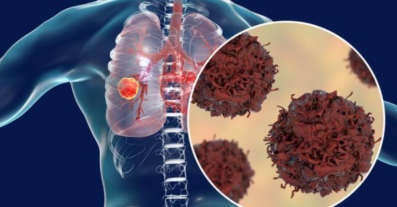 U phổi – Căn bệnh có xu hướng ngày càng tăng nhanh trên toàn cầu 