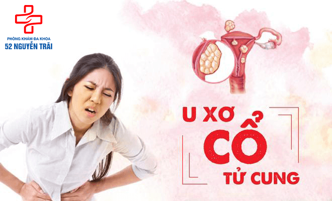 Cách chữa bệnh u xơ tử cung hiệu quả nhất