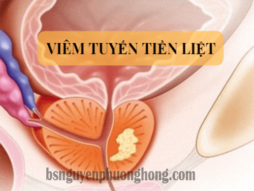 Bác sĩ Nguyễn Phương Hồng: Điều trị viêm tuyến tiền liệt như thế nào?
