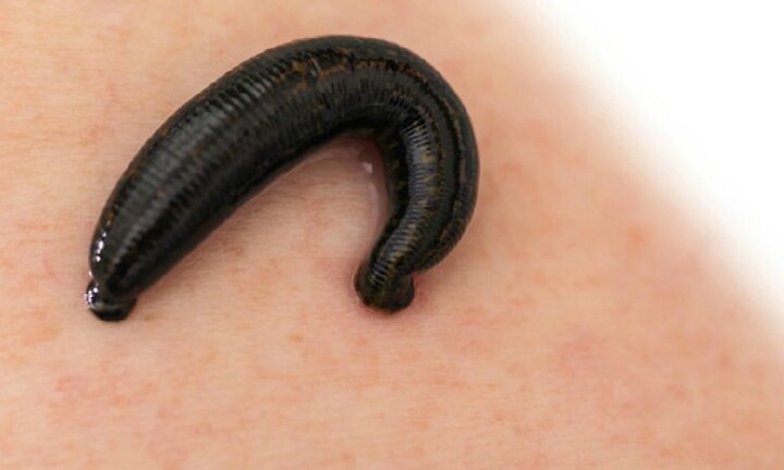 Gắp đỉa sống dài 7,5cm sống ký sinh trong khí quản bé trai