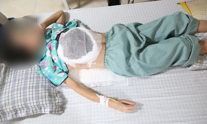 Chữa ung thư vú bằng thuốc nam, nữ bệnh nhân nằm chờ chết do hoại tử