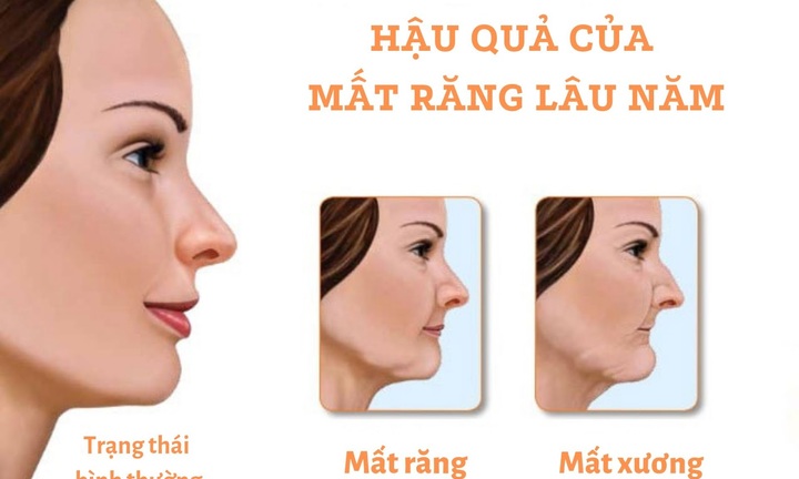 Mất răng: Nguyên nhân hàng đầu gây mất trí nhớ - Làm sao để khắc phục hiệu quả?
