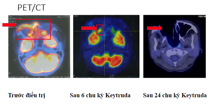 Thuốc miễn dịch kéo dài thời gian sống cho bệnh nhân ung thư giai đoạn muộn 