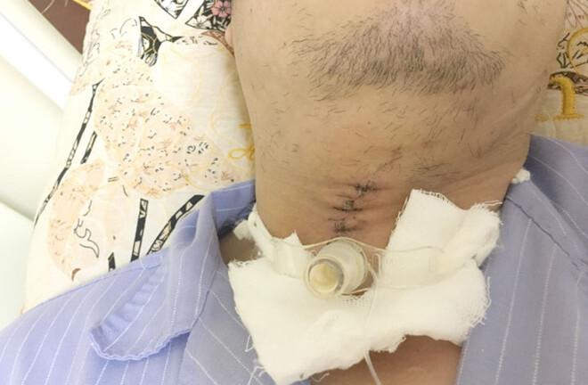 Quảng Ninh: Cứu sống người đàn ông bị đá mài bắn văng thủng cổ