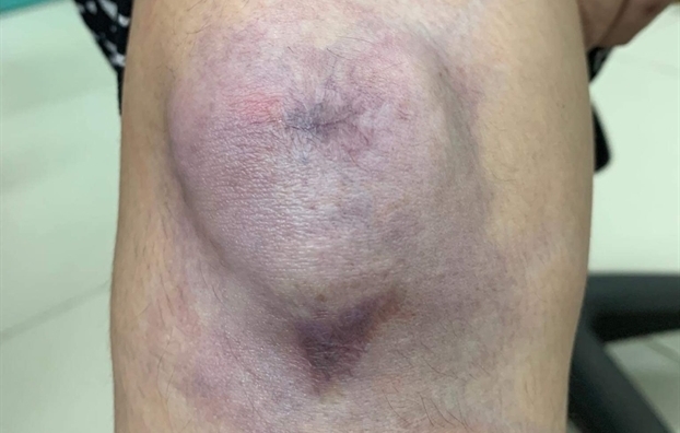 Sẹo lồi nhỏ như đầu đũa biến to gần bàn tay do chữa ở spa