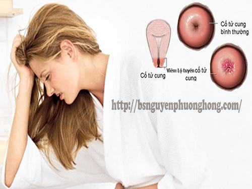 Tổng hợp các cách chữa viêm lộ tuyến cổ tử cung tốt nhất 
