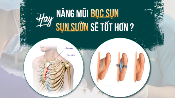 Nên nâng mũi bọc sụn hay nâng mũi sụn sườn sẽ tốt hơn?