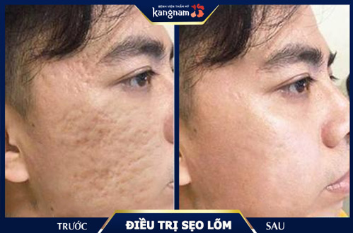 Cơ chế hình thành sẹo lõm sau mụn và cách điều trị hiệu quả 