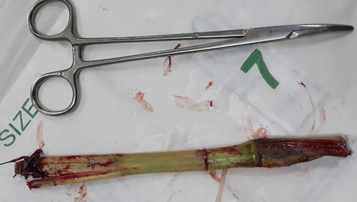 Hà Tĩnh: Bé trai 8 tuổi bị gốc cỏ đâm thủng bụng khi chơi đùa