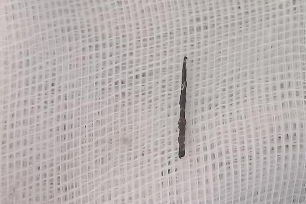 Hãi hùng cô gái bị kim khâu đâm vào mông suốt 8 tháng trời không biết