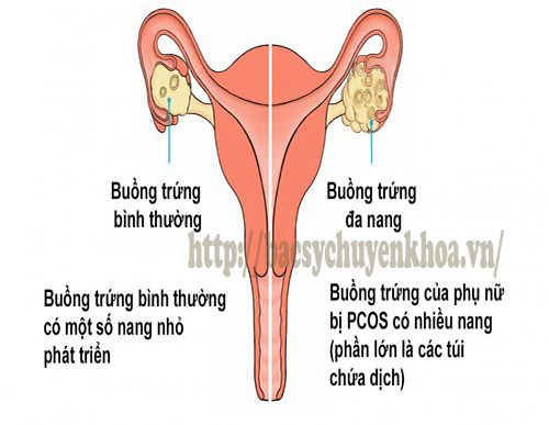 Buồng trứng đa nang sau sinh: Những điều chị em cần biết
