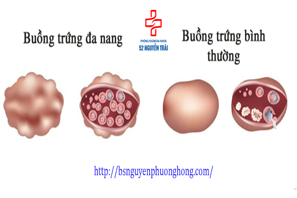 Sự thật về việc vì sao buồng trứng có nhiều nang nhỏ