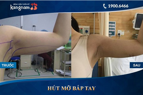 Giảm cấp tốc 4 - 6cm bắp tay với công nghệ hút mỡ 4.0