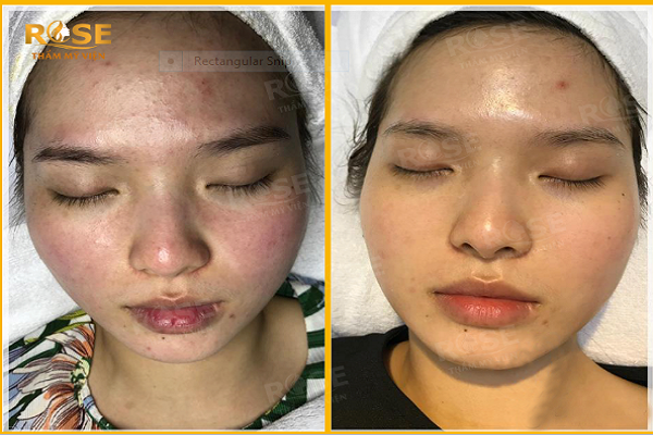 Lăn kim có tác dụng gì trong việc làm đẹp