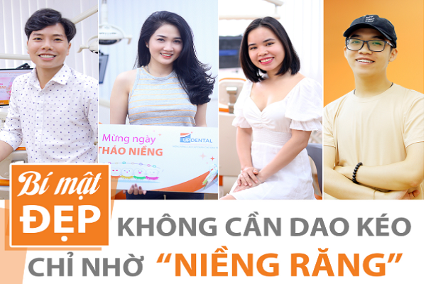 Niềng răng mất bao lâu để xinh đẹp - Bí quyết tự tin không cần dao kéo