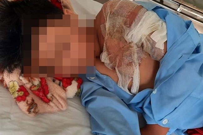 Cha tạt nước sôi khiến con bị bỏng nặng: Tức giận nhất thời, ân hận cả đời