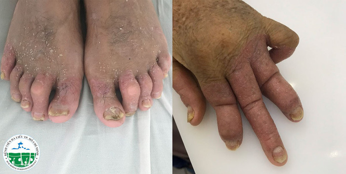Uống thuốc nam chữa bệnh vảy nến, người đàn ông lở loét, biến dạng toàn thân